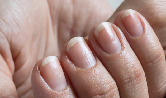 Vertical Ridges on Nails: Is It a Vitamin Deficiency?